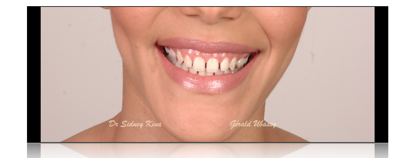 12 Veneers, Kina /Ubassy